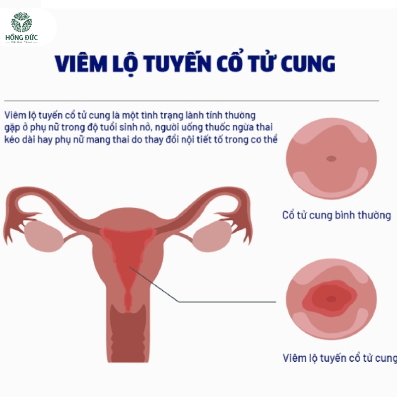 Thuốc trị viêm lộ tuyến: Hướng dẫn chi tiết từ chuyên gia phụ khoa 6 Viêm Lộ Tuyến Cổ Tử Cung