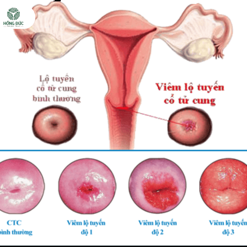 Phác đồ điều trị viêm lộ tuyến tử cung: Hướng dẫn chi tiết và hiệu quả 12 7