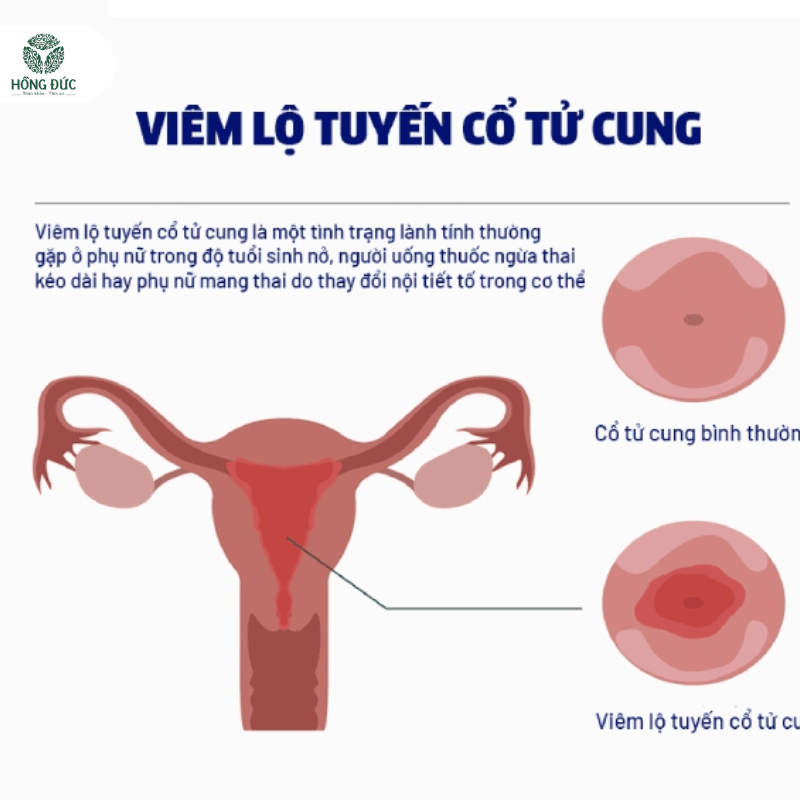 Viêm Lộ Tuyến Cổ Tử Cung